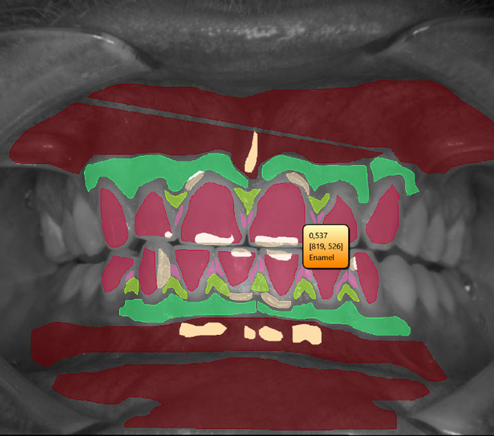 Oral-Dental-Data-Analysis-Using-LightningChart-by-University-Eastern-Finland