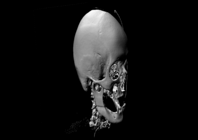 volume-rendering-skull-iso-surface